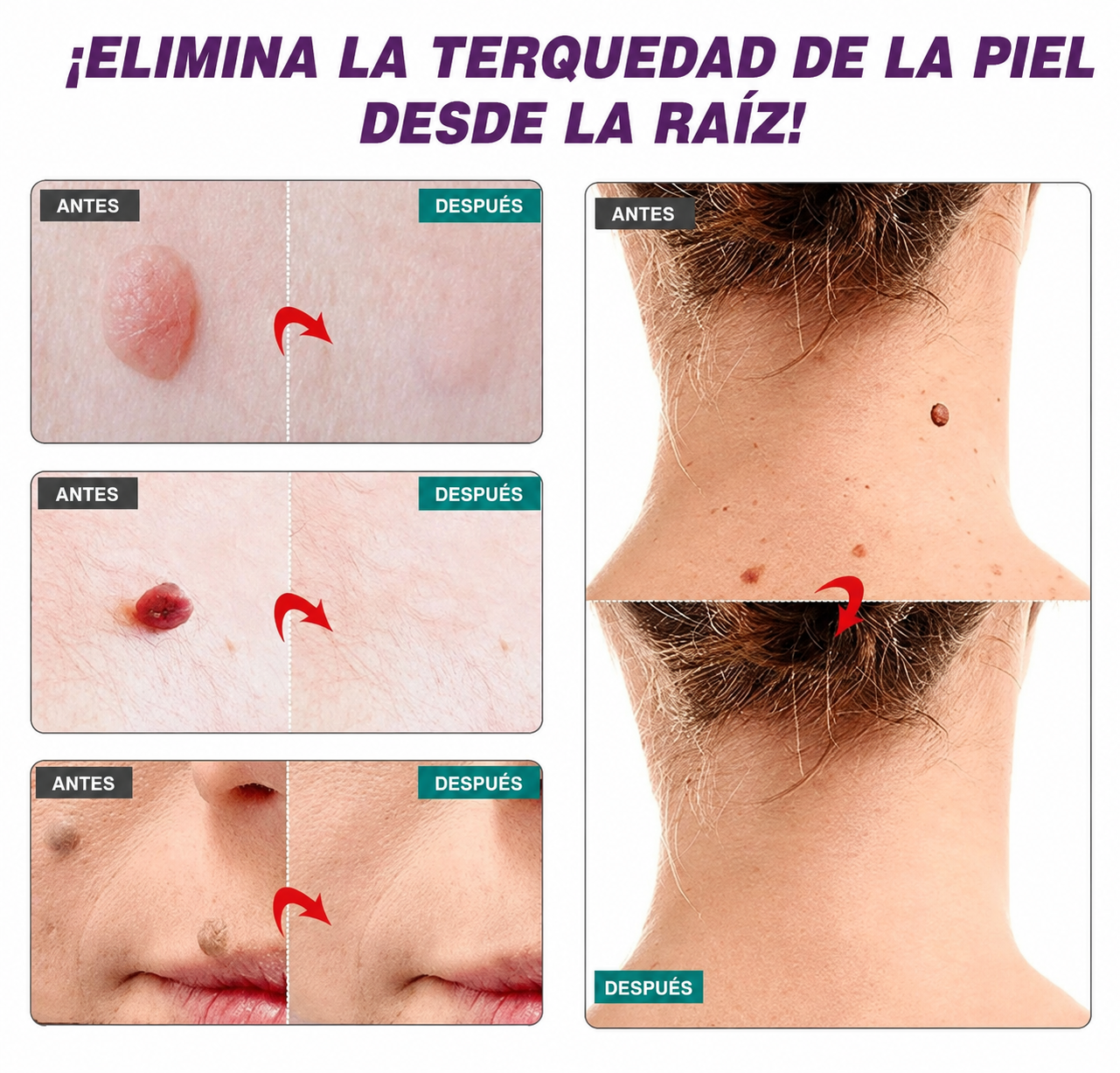 WART REMOVER│Elimina Verrugas