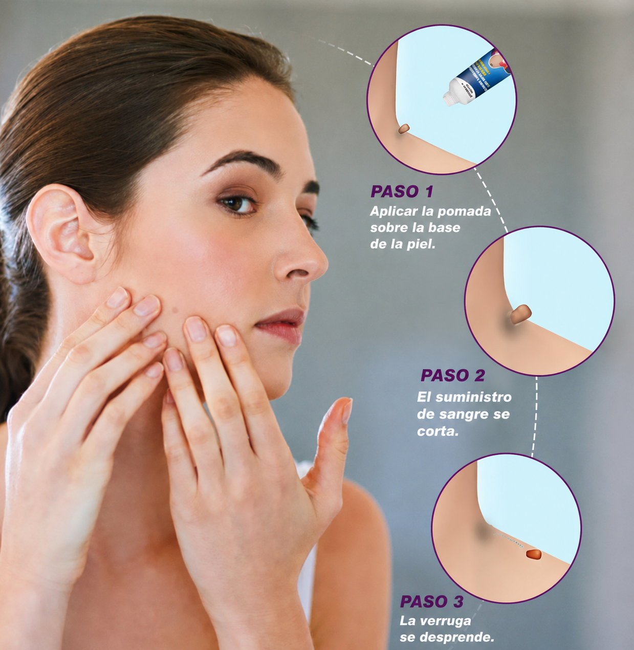 WART REMOVER│Elimina Verrugas